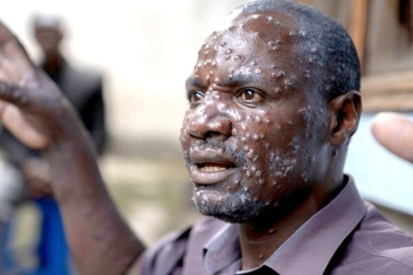 MPOX CASES IN MALAWI