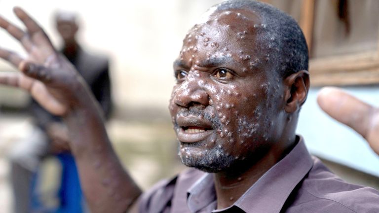 MPOX CASES IN MALAWI